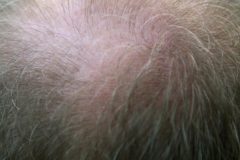 Finasteride : les limites de ce remède contre la calvitie