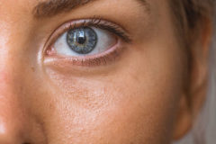 pores dilatés