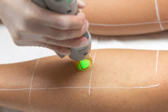 Epilation : lumière pulsée ou laser