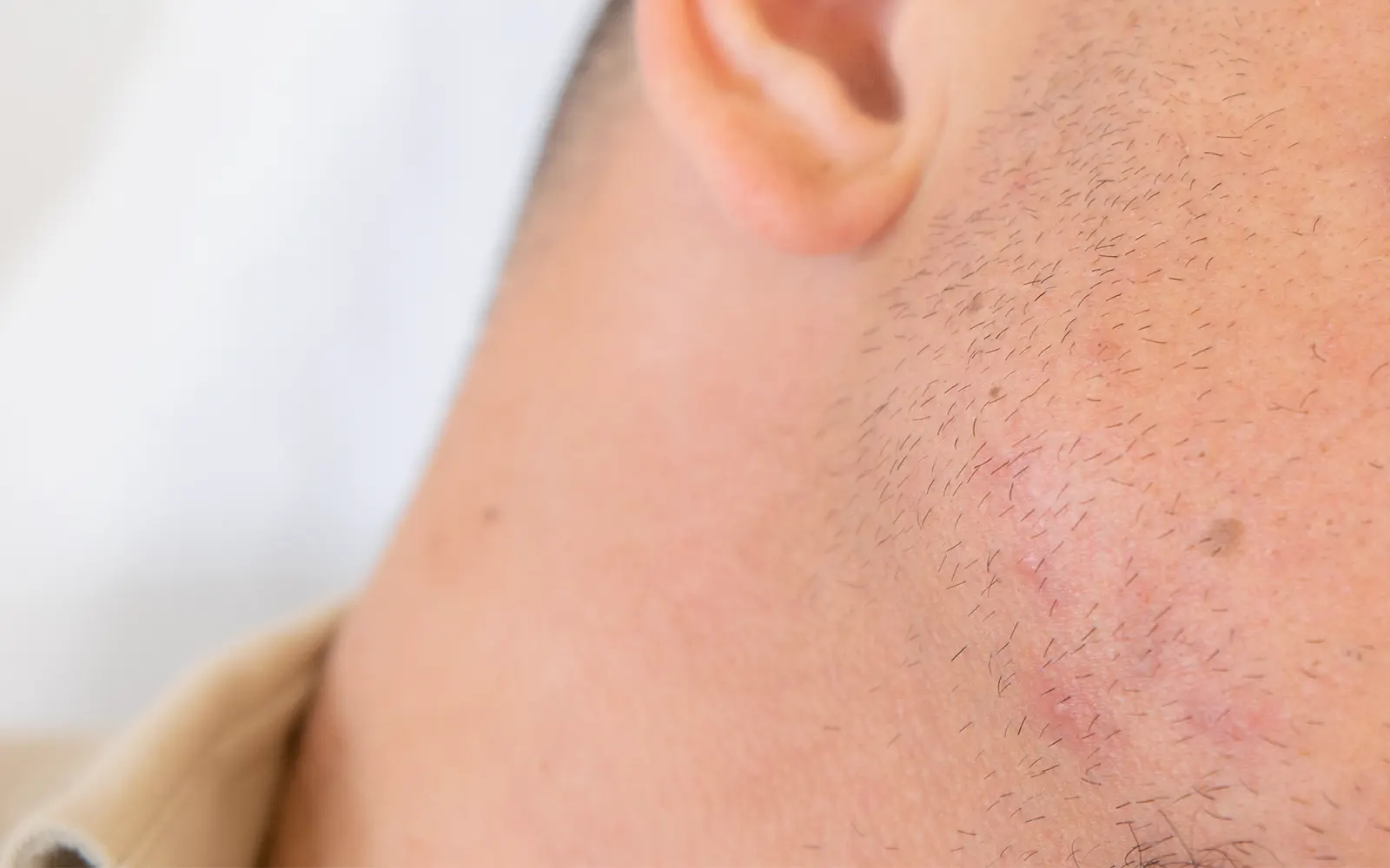 Cicatrices d'acné pigmentées sur le visage