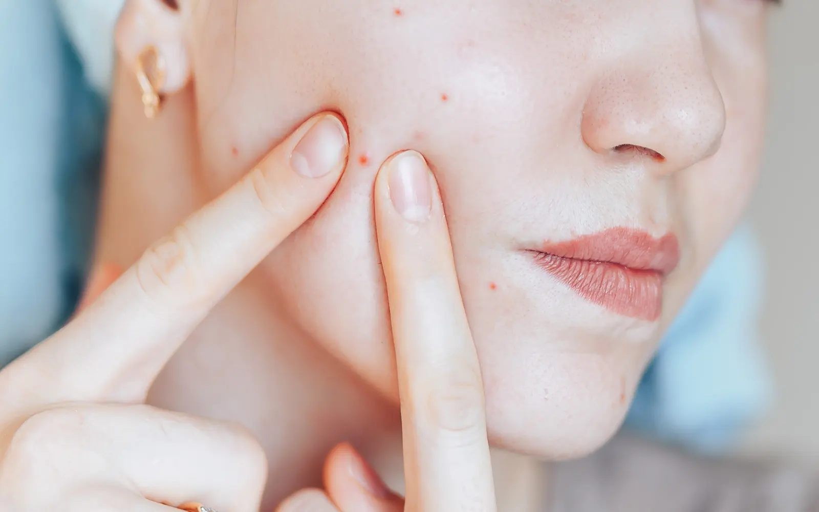 Bouton d'acné : comment les éviter durant votre été ?