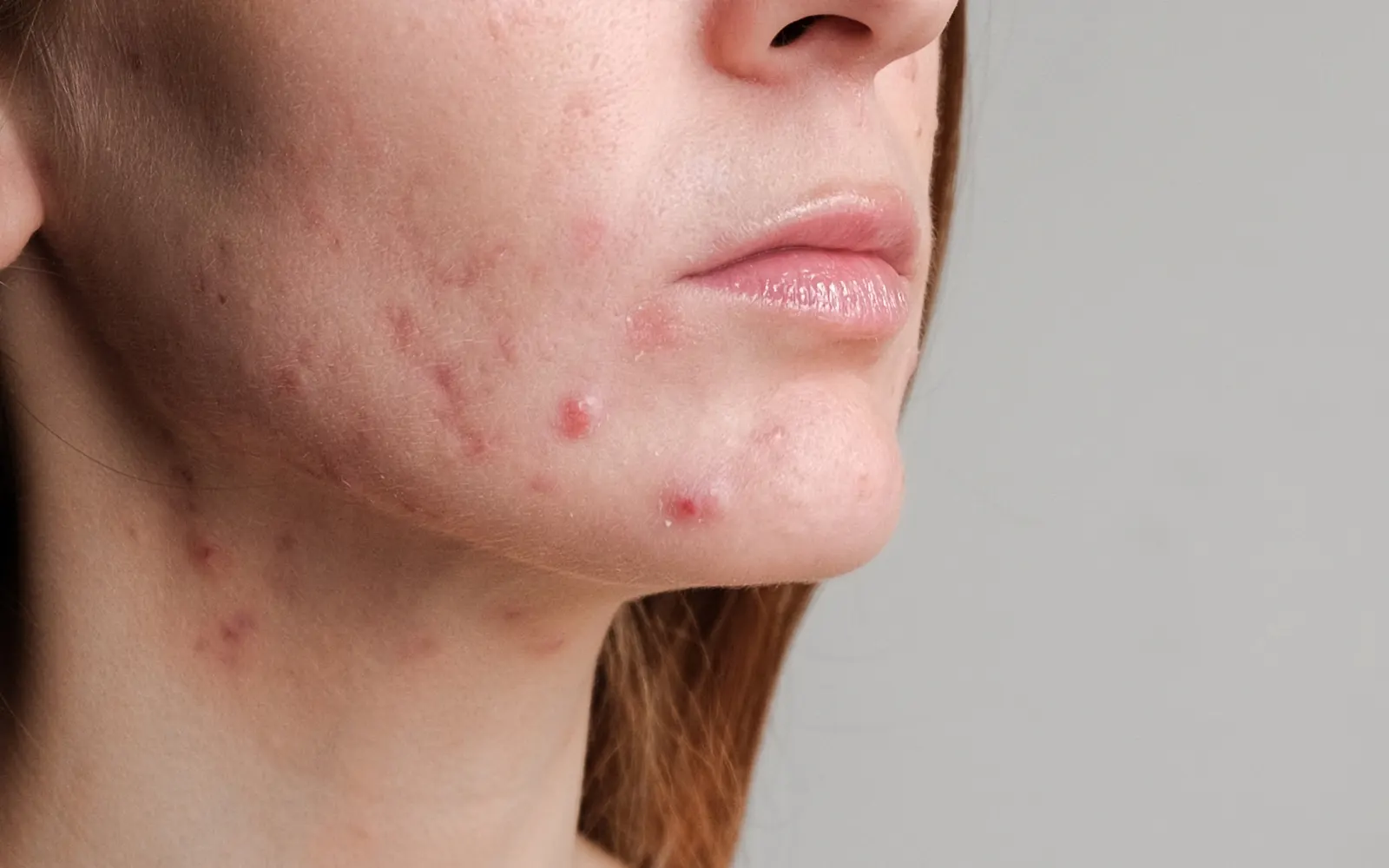 https://dermomedicalcenter.com/wp-content/uploads/2023/03/acne-hormonale.webp